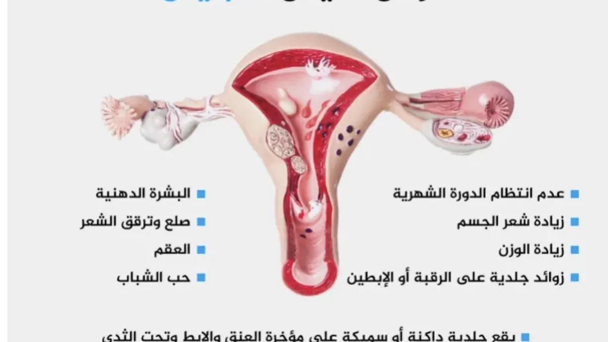 أعراض تكيسات المبايض 7 علامات شائعة ومتى تستدعي الطبيب؟